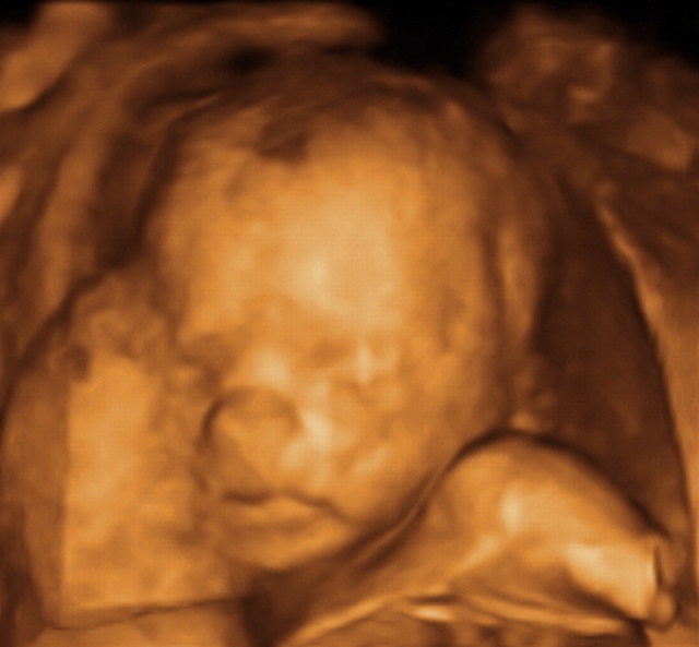 3-D Ultraschall (Fetomed) 21. Woche